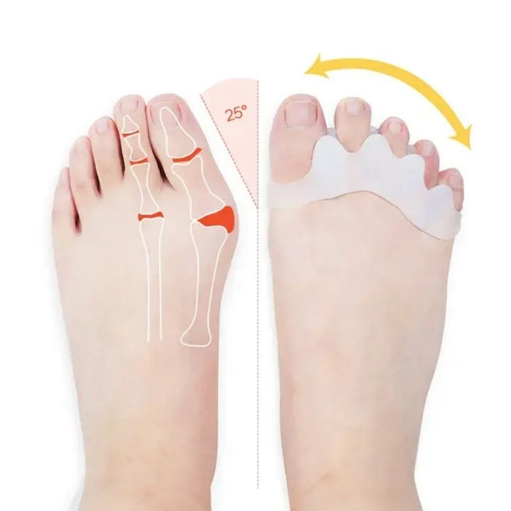 Elastisk Tåseparerare för Hallux Valgus med Silikon Skydd | Bekväm Tåspridare för Optimal Stöd 1